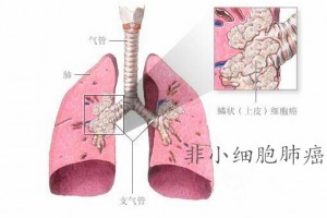 非小细胞肺癌的精准医治为什么挑选香港就医