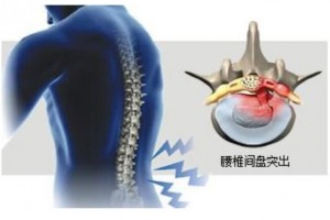 巨大型或游离型腰椎间盘突出症一定要手术未必