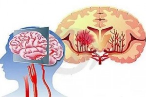 脑出血前的10大救命信号紧记这7条预防措施